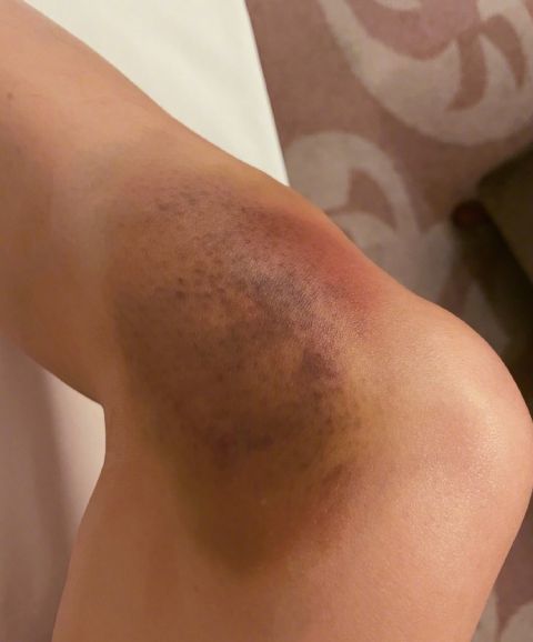 张馨予晒腿部淤青照 笑侃:现在跳舞我也有调色盘