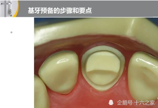 全冠的牙体预备《前后牙》