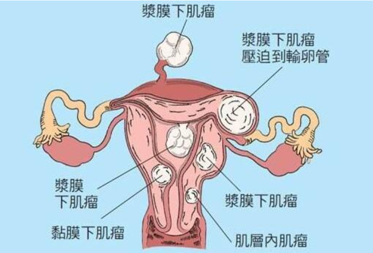 白带是阴道黏膜渗出物,宫颈管及子宫内膜腺体分泌液混合而成,子宫肌瘤