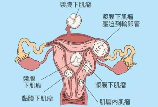 子宫肌瘤引起的不规则阴道出血和月经量增多短期并不会导致贫血,时间