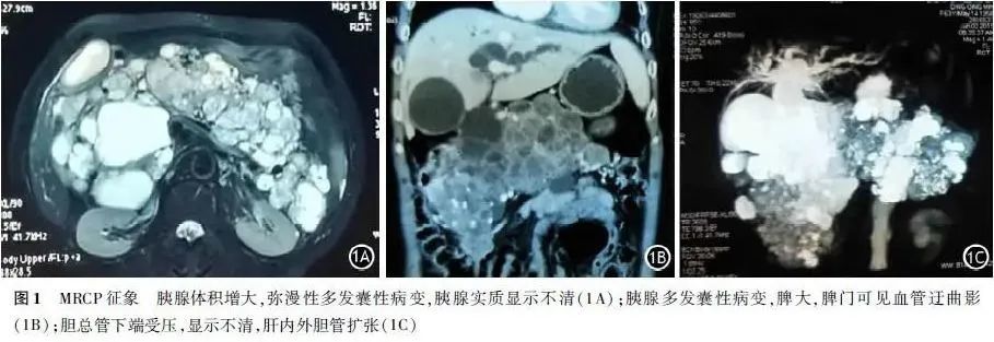 病例报告|以多囊胰腺为并发表现的vhl综合征一例