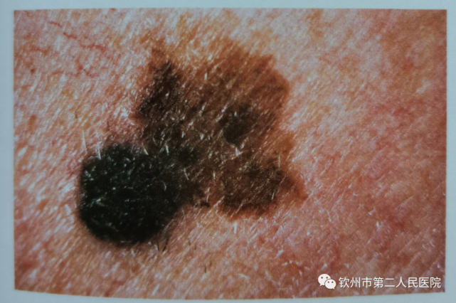 皮肤浅表扩散型恶性黑色素瘤
