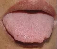 齿痕舌 舌体比较肥胖,舌苔比较薄,在舌体的两边会明显有牙齿印,这就是