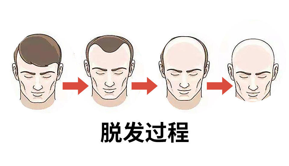 为何脱发容易头顶先秃?看育发顾问怎么说