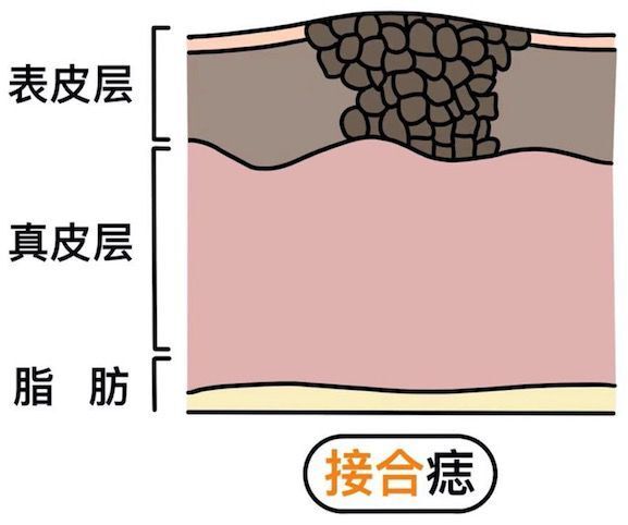 真皮痣,位于真皮层,上面被表皮层覆盖了,较大,突起明显或长毛