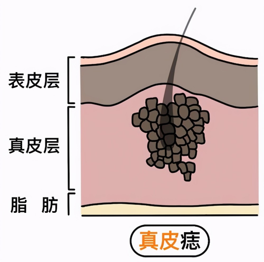 脸上有很多痣,想去掉,又怕留疤,怎么办?