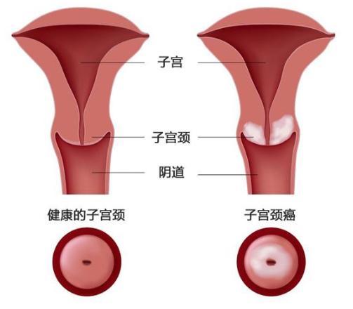 双腿或会先知,提醒:出现3种异常,别大意|宫颈|白带异常|宫颈疾病|hpv