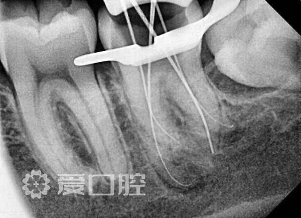 根管治疗罕见的四根管下颌第二磨牙1例