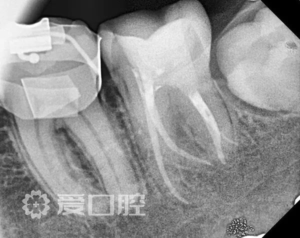 根管治疗罕见的四根管下颌第二磨牙1例