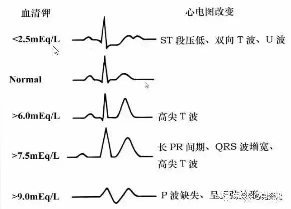 t波高尖可能会是哪些疾病