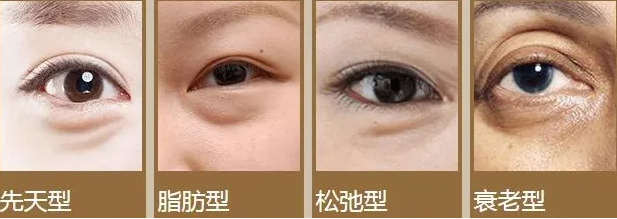 眼袋主要分为先天型眼袋,脂肪型眼袋,衰老型眼袋,松弛型眼袋4种类型.