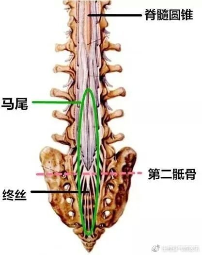 1.腰椎间盘突出导致压迫马尾神经