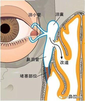 疗效好,正逐渐成为反复发作慢性泪囊炎的首选治疗手段