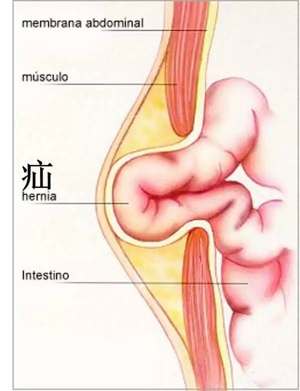 药物和疝气带疗法只能暂时抑制疝的症状,而不能从根本上解决疝气病根