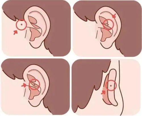 不过,也有一些开口位置在耳后和外耳道,以及耳廓的其他部位.