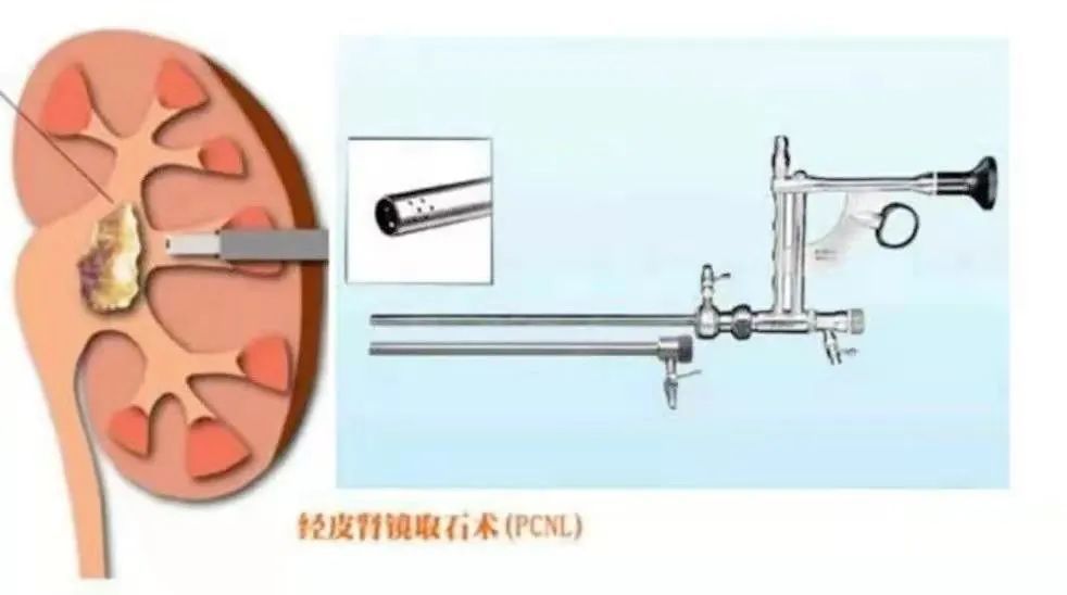 经皮肾镜取石术清除肾脏"顽石!