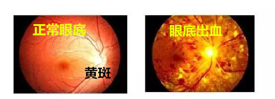 有糖尿病和高血压的人,看东西模糊有时还有黑影,来看看这张图吧