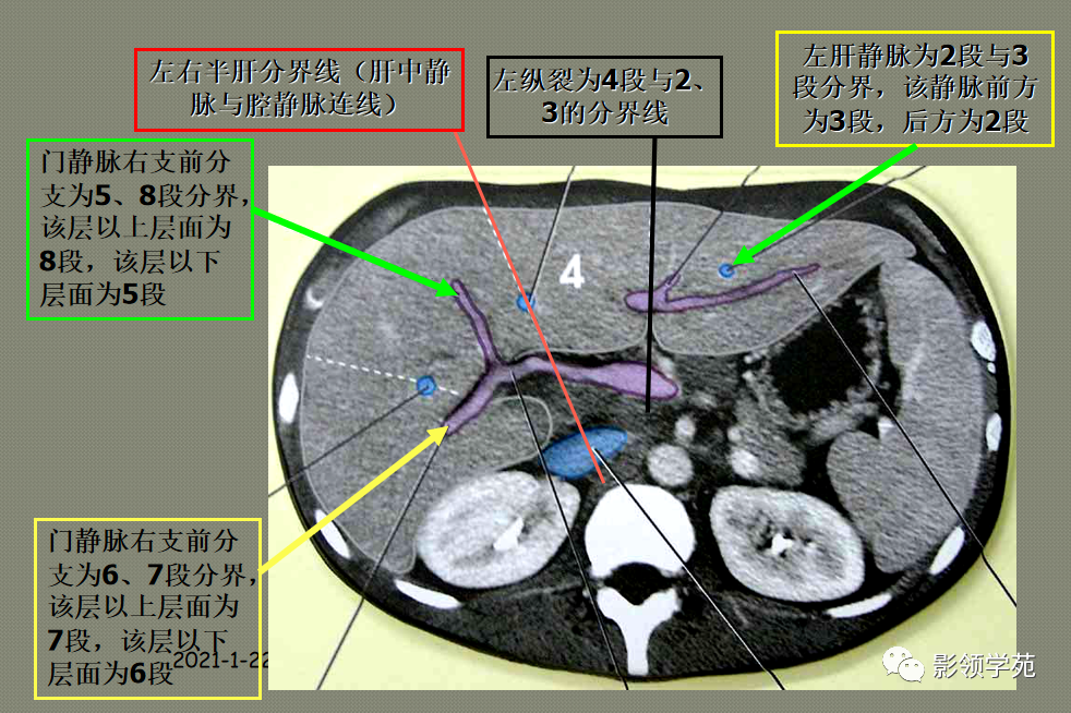 第一肝门层面ct横断面解剖