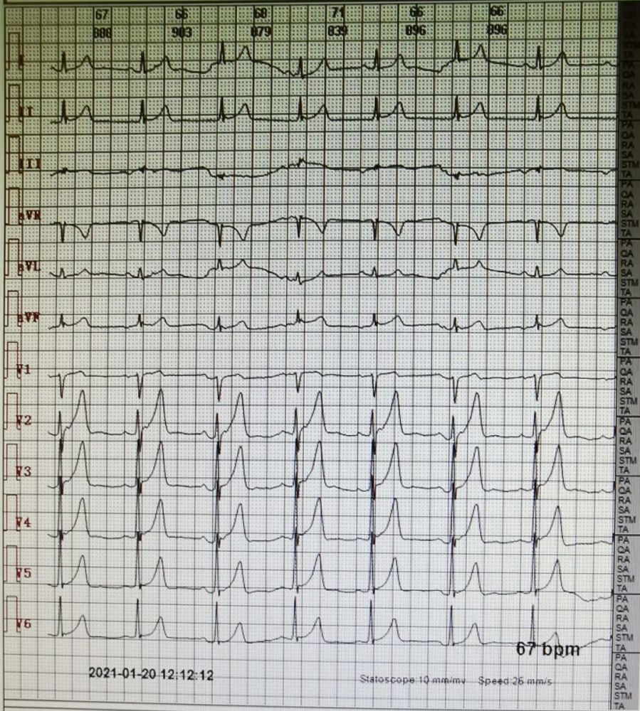 会诊患者,中年男性,未述特殊不适,入院心电图如下