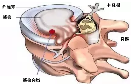 多节段腰椎间盘突出怎么办?微创理念下开放手术效果好!