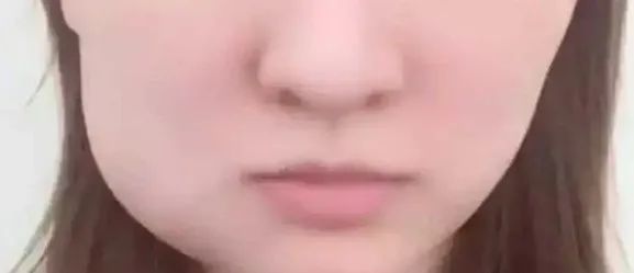 牙科小知识:拔完智齿,脸却肿成猪头?其实这不是医生的