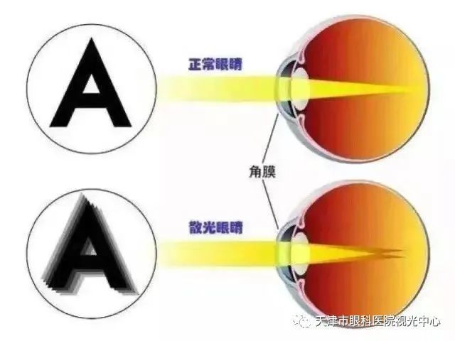 清,而且看远处发光或者反射光的物体周围会有光圈,严重者还会出现重影