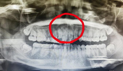 多生牙科普小知识|多生牙|牙齿|乳牙|牙龈