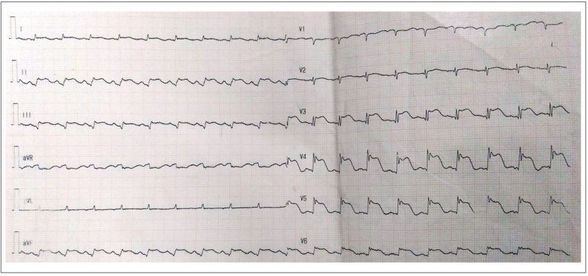 病例|罕见!心肌心包炎出现三角形qrs-st-t样心电图改变
