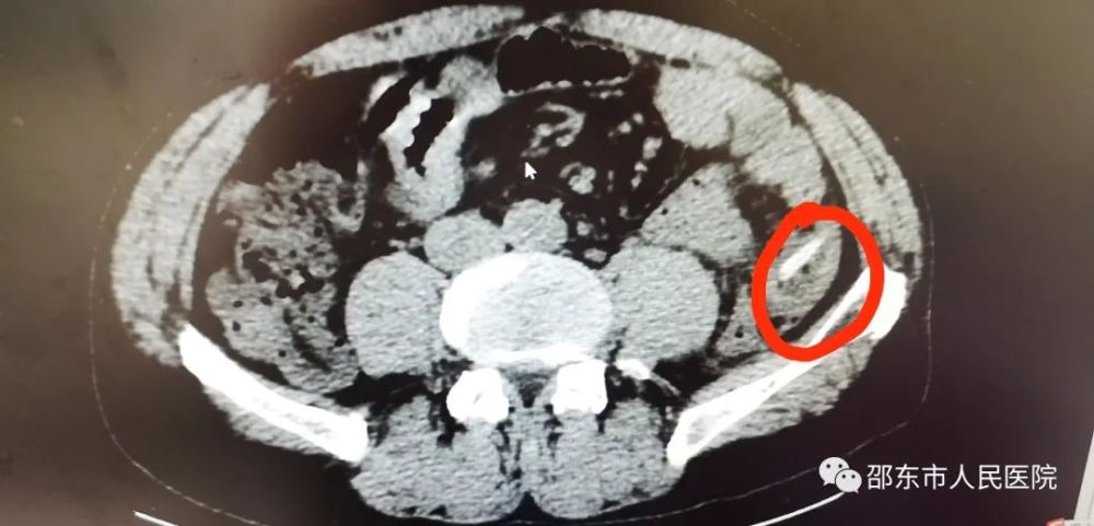 邵东灵官殿一男子吃瓜果致肠穿孔!啥情况?_腾讯新闻