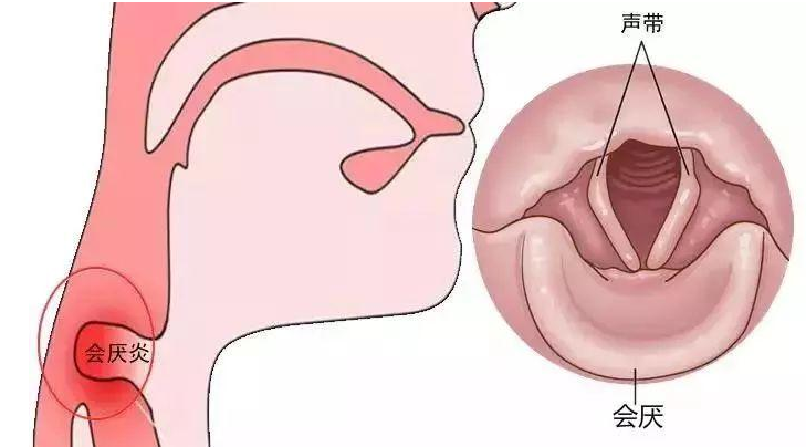 会厌是喉的软骨之一,呈叶片状,当我们吞咽食物时,会厌软骨盖住气管