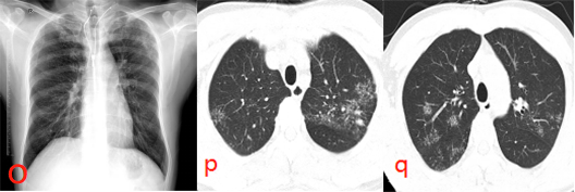 肺纤维条影可以自愈_右肺中叶纤维条索影_肺部中叶索条影和微小结节