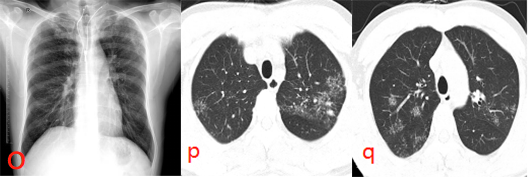 图 o-p-q 即结核的「烟花征」,为在 ct 上表现为肺内多发小叶中央