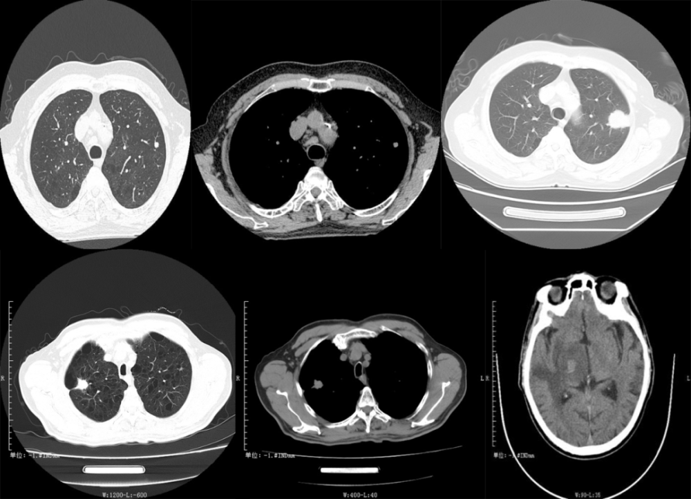 总之,简单一句话,肺结核的 ct 特点: 三多三少:多灶性,多态性,多钙化