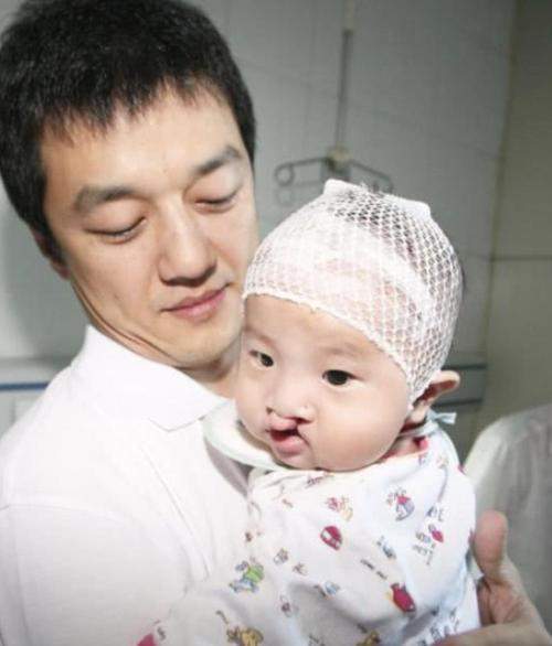 李嫣摘掉兔唇女孩的标签3次手术很成功15岁像极了王菲