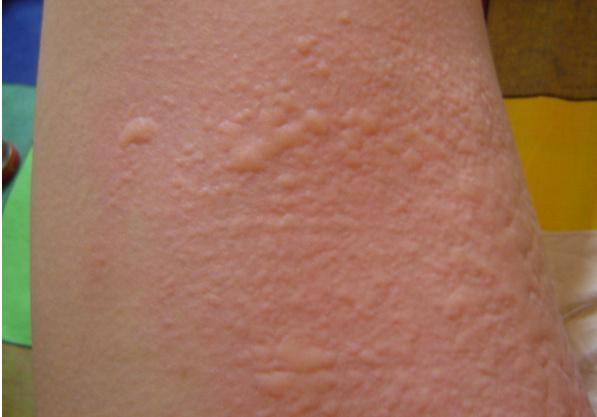春季,皮肤上突然出现的"小疙瘩",可能荨麻疹正在慢慢"