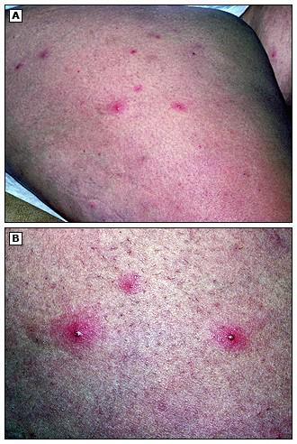 另一种背部长痘的常见情况是毛囊炎.
