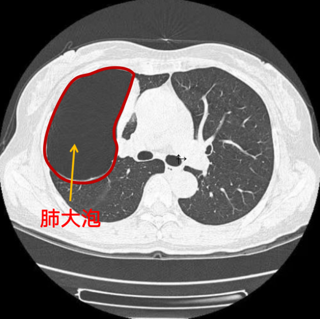 肺大泡是不可逆的肺部病变,无法用药根治,这种生活习惯的人基本都有肺