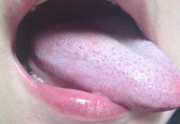 幽门螺杆菌入胃后,嘴巴或会出现3个异常,不妨对照自查