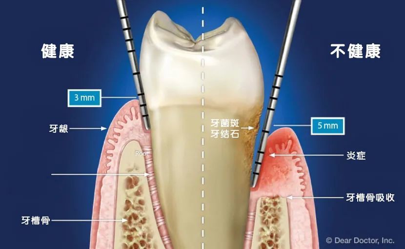 洗牙后医生建议做"龈下刮治",很疼吗,有必要做吗?