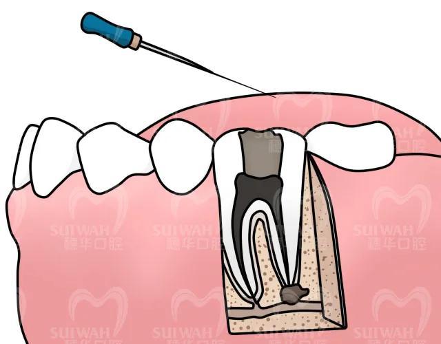 为什么牙齿表面只有一个小洞,却严重到需要根管治疗?