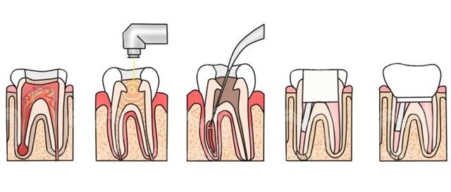 为什么牙齿表面只有一个小洞,却严重到需要根管治疗?_腾讯新闻