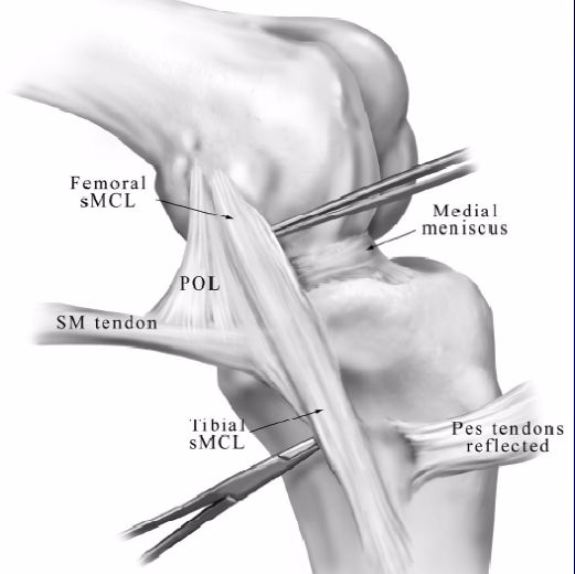 内侧副韧带(medial collateral ligament, mcl)  起自股骨内收肌结节