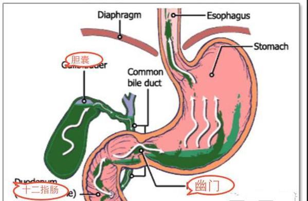 幽门失守胆汁反流兴风作浪医生这种病想根治需改善这些习惯