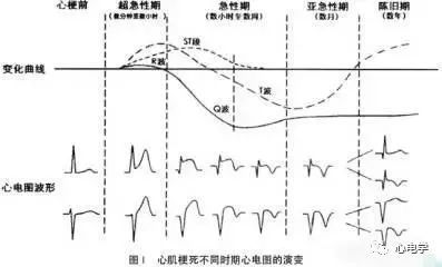 在下壁导联ii,iii和avf导联上更可能出 现q波