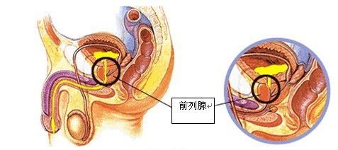 急性细菌性前列腺炎的症状有哪些?