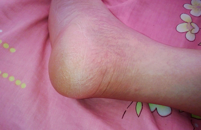 鳞屑角化型脚气症状图