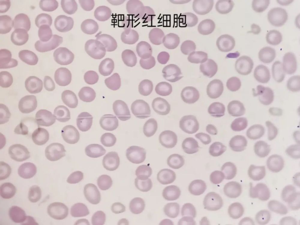 图为正常红细胞红细胞形态给我们的反馈part1一张血片能否看出血液