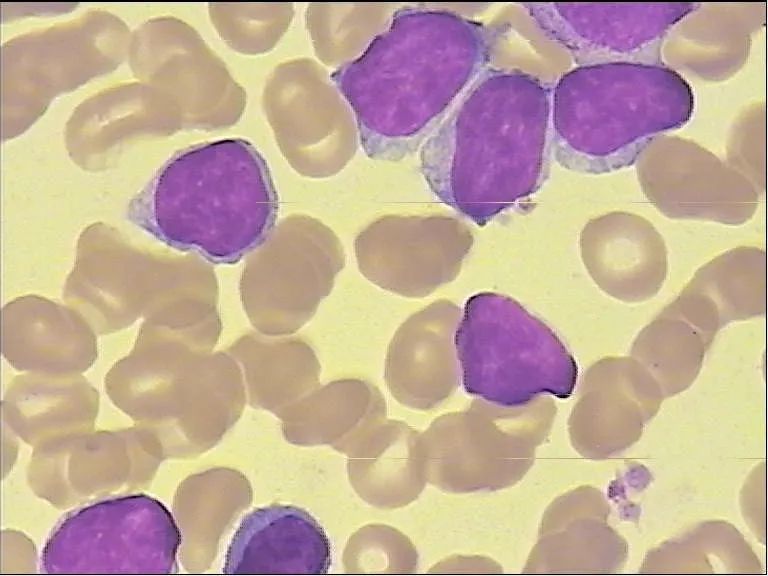 图为异常淋巴细胞 淋巴瘤细胞白血病(mcl可能)