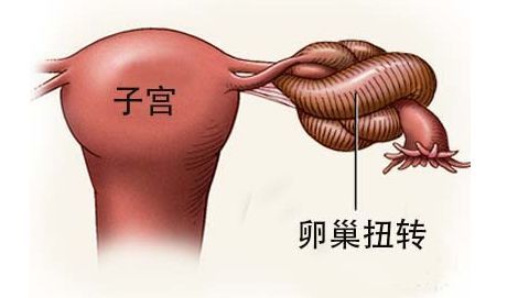 美亚科普|试管婴儿促排卵后需警惕卵巢扭转