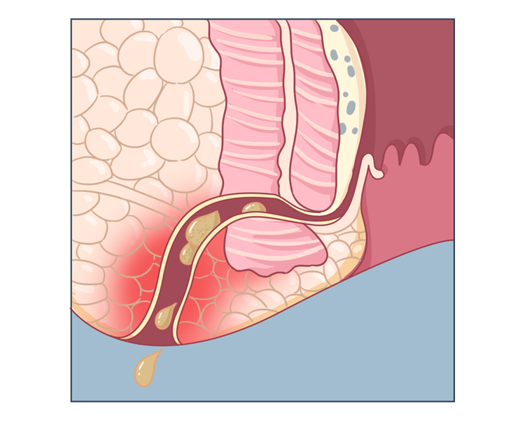 肛瘘患者:"不想治了,我真的太痛了!"肛瘘手术,到底有多痛?
